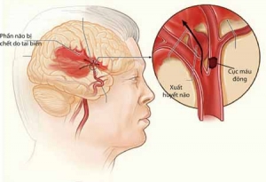 Xuất huyết não ở người già có nguy hiểm không? Cần lưu ý biến chứng gì?