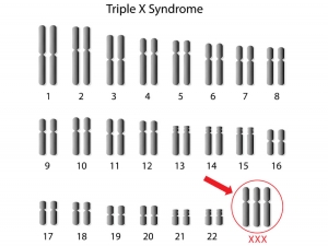 Hội chứng siêu nữ (hội chứng 3X): Nguyên nhân, triệu chứng, chẩn đoán và điều trị