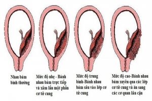 Nhau cài răng lược: Nguyên nhân, triệu chứng, chẩn đoán và điều trị