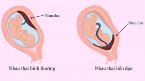 Thế nào là rau tiền đạo?