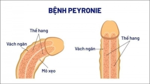 Bệnh peyronie - Căn bệnh nam giới cần đặc biệt lưu ý