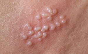 Herpes sinh dục: Hình ảnh, triệu chứng và điều trị