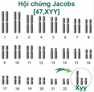 Hội chứng XYY: Nguyên nhân, triệu chứng, chẩn đoán và điều trị